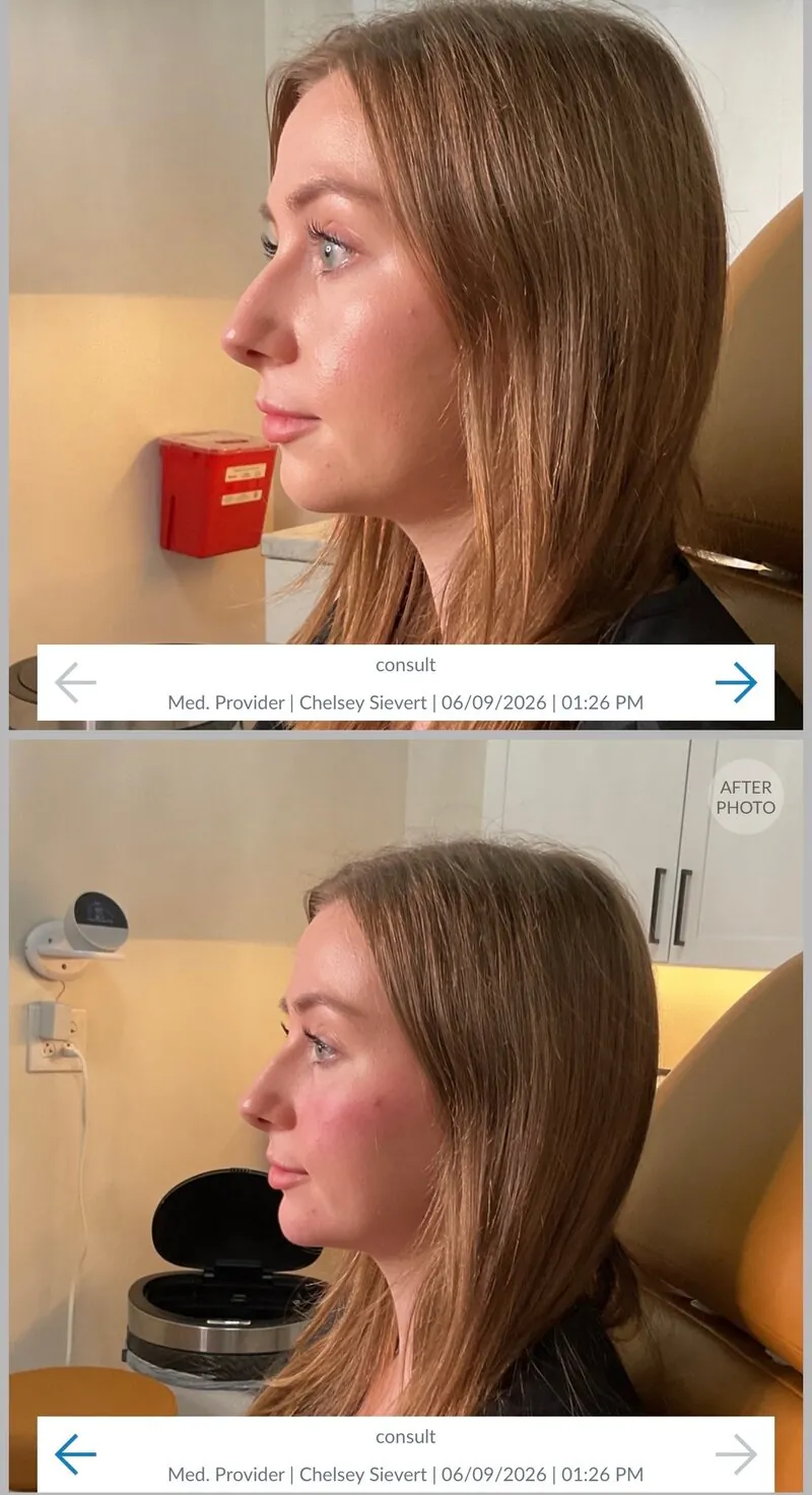 Chin Filler results at CC Aesthetics in Lexington KY